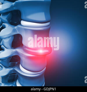 Immagine 3d di ernia del disco vertebrale umana Foto Stock