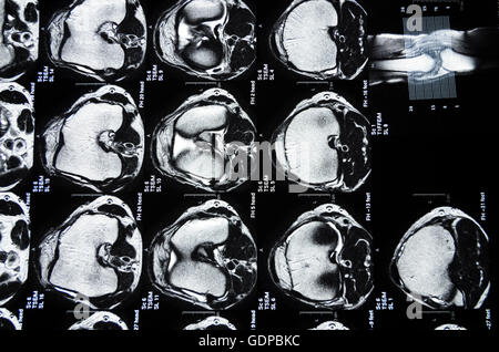 : Imaging a risonanza magnetica ( MRI ) : delle immagini a sezione trasversale di un ginocchio, , , Foto Stock