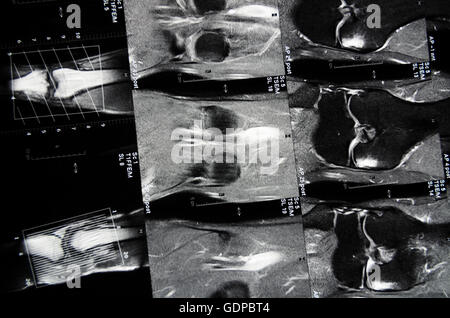 : Imaging a risonanza magnetica ( MRI ) : delle immagini a sezione trasversale di un ginocchio, , , Foto Stock