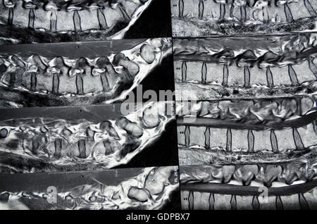 : Imaging a risonanza magnetica ( MRI ) : delle immagini a sezione trasversale della colonna vertebrale lombare, , , Foto Stock