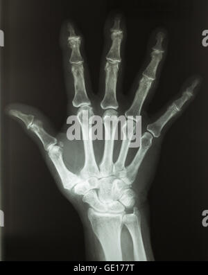 X-Ray della mano umana dalla vista dall'alto con le dita si diffondono. Foto Stock