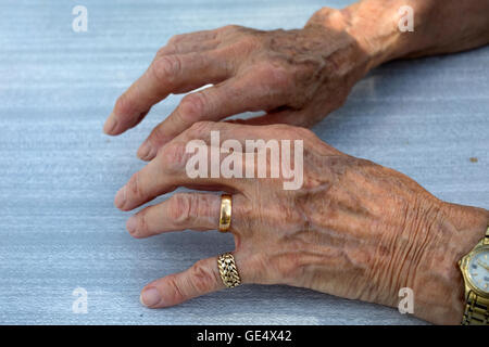 Artrite mani artritiche donna anziana regno unito Foto Stock