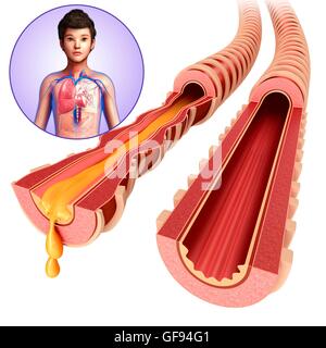 Illustrazione di adolescente di bronchi infetti. Foto Stock