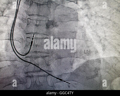 Pacemaker DDDR cavo in immagine a raggi x in un cateterismo cardiaco laboratorio Foto Stock