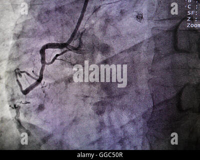 STEMI in arteria coronaria destra da raggi x in un cateterismo cardiaco laboratorio Foto Stock