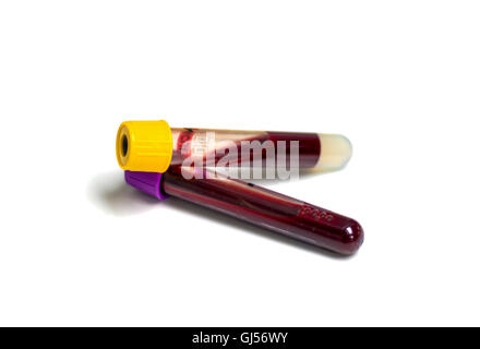 Campione di sangue su sfondo bianco Foto Stock
