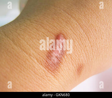 Cicatrice sul umano pelle bruciata da acqua calda Scotti, il fuoco selettivo Foto Stock