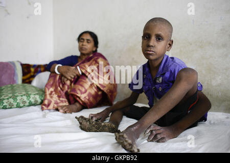 Dacca in Bangladesh. Il 22 agosto, 2016. Ripon Roy, 7, dal distretto di Thakurgaon, si siede sul letto di un ospedale a Dhaka, nel Bangladesh, Agosto 22, 2016. Ripon è stato colpito dalla struttura ad albero uomo malattia, una rara malattia della pelle causata da un virus chiamato papillomavirus umano. Ripon è una classe II studente di governo Ketgaon la scuola primaria è stata colpita quando lui aveva solo tre-mese-vecchio, detto Mohendra Roy, suo padre. Le verruche ha cominciato a sviluppare il palmo della mano e del piede che sono sempre più, ha detto, mentre in cerca di aiuto per suo figlio un trattamento migliore. Credito: Suvra Kanti Das/ZUMA filo/Alamy Live News Foto Stock