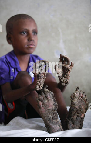 Dacca in Bangladesh. Il 22 agosto, 2016. Ripon Roy, 7, dal distretto di Thakurgaon, si siede sul letto di un ospedale a Dhaka, nel Bangladesh, Agosto 22, 2016. Ripon è stato colpito dalla struttura ad albero uomo malattia, una rara malattia della pelle causata da un virus chiamato papillomavirus umano. Ripon è una classe II studente di governo Ketgaon la scuola primaria è stata colpita quando lui aveva solo tre-mese-vecchio, detto Mohendra Roy, suo padre. Le verruche ha cominciato a sviluppare il palmo della mano e del piede che sono sempre più, ha detto, mentre in cerca di aiuto per suo figlio un trattamento migliore. Credito: Suvra Kanti Das/ZUMA filo/Alamy Live News Foto Stock