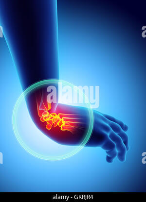 Polso doloroso - scheletro x-ray 3D illustrazione concetto medico. Foto Stock