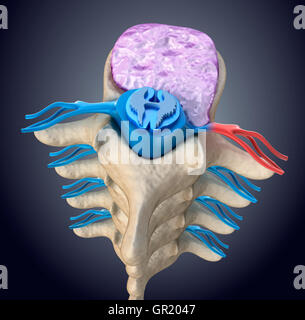 Il midollo spinale sotto pressione di rigonfiamento disc Foto Stock