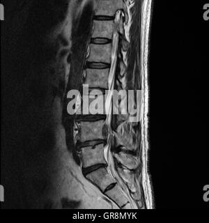 Mri di una formazione di ernia Lumbar-Disk Foto Stock