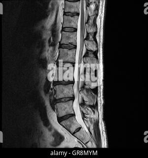 Mri di una formazione di ernia Lumbar-Disk Foto Stock