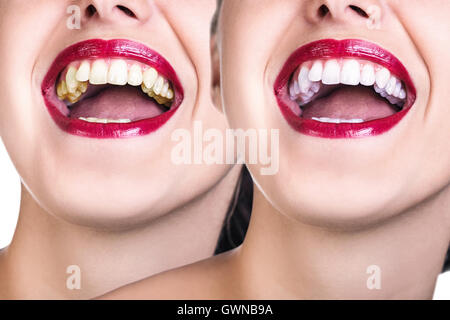 Prima e dopo lo sbiancamento dei denti. Foto Stock