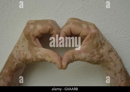 Mano e avambraccio di un uomo con la vitiligine condizione della pelle. Le mani e le braccia con la vitiligine rendendo la forma del cuore. Foto Stock