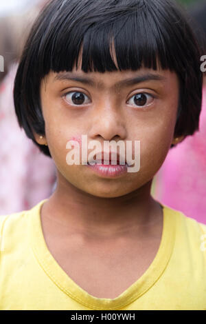 ELLA, SRI LANKA - Marzo 2, 2014: Ritratto dello Sri Lanka la ragazza con la sindrome di Down. 24.000 casi di sindrome di Down sono stati annunci Foto Stock