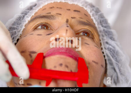 Closeup womans affrontare la preparazione per la chirurgia estetica con le linee tracciate sulla pelle medico misura tramite l'attrezzo, come visto da sopra Foto Stock