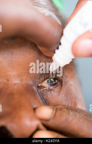 Ospedale Ribaue, Ribaue, Nampula Provincia, Mozambico, Agosto 2015. Una cataratta è chiaramente visibile sul paziente dopo essere stato dato scende a dialate la pupilla e presto per avere il suo funzionamento per rimuovere la cataratta. Foto di Mike Goldwater Foto Stock