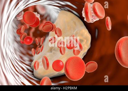 Placche ateromatose all'interno del vaso sanguigno, illustrazione del computer. Colesterolo ateroma causando un restringimento di una arteria (aterosclerosi). Foto Stock
