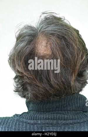 Maturo uomo yang, visto da dietro, nella testa, comincia a perdere i capelli, comincia ad essere vecchio. Foto Stock