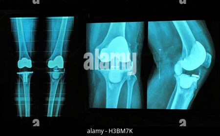 Sostituzione del ginocchio xray Foto Stock