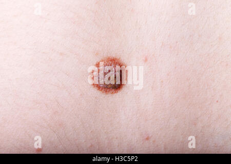 Una grande mole sul corpo di una donna, close-up, Medicina, salute Foto Stock