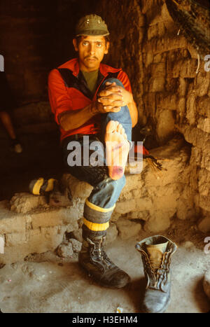 GUAZAPA, EL SALVADOR, FEB 1984: - all'interno del FPL Guerilla's zone di controllo - Una milizia stati mostra il vampiro bat morsi sul suo piede. Foto Stock