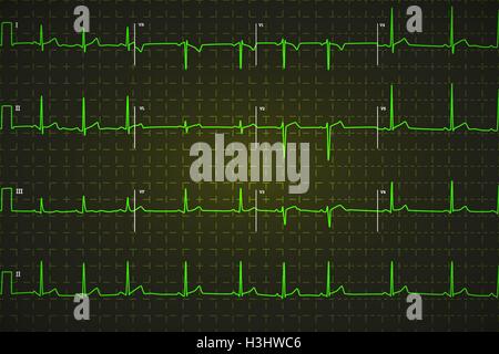 Tipico elettrocardiogramma umano, verde brillante grafico su sfondo scuro Illustrazione Vettoriale