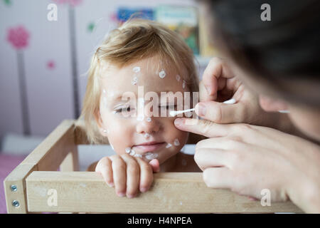 Bambina con la varicella, antisettico crema applicata alla ras Foto Stock