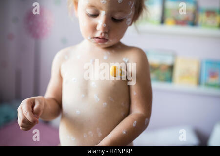 Bambina con la varicella, antisettico crema applicata alla ras Foto Stock