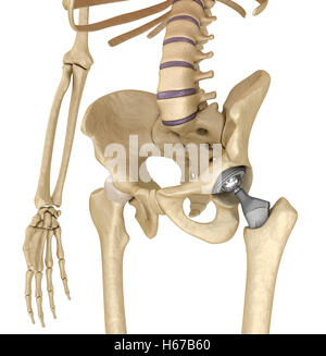 Anca sostituzione impianto installato in l'osso del bacino. Accurata dal punto di vista medico 3D illustrazione Foto Stock