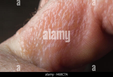 Close up macro poison ivy rash vesciche sulla pelle umana Foto Stock