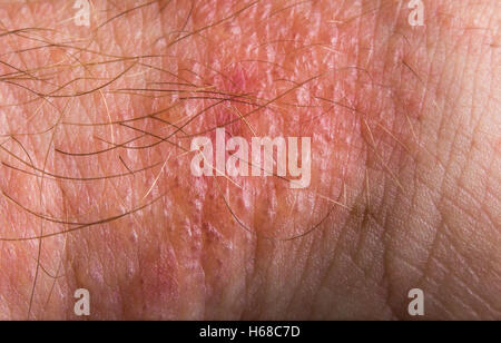 Close up macro poison ivy rash vesciche sulla pelle umana Foto Stock