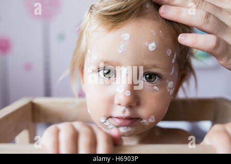 Bambina con la varicella, antisettico crema applicata a rash Foto Stock