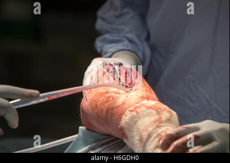 La fissazione esterna della testa radiale del gomito.chirurghi eseguono un'operazione a gomito Foto Stock