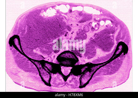 L'amiloidosi CT-SCAN Foto Stock