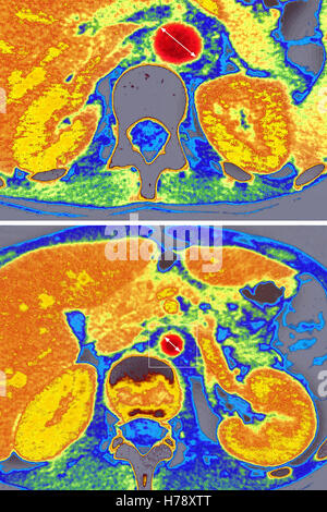 TAKAYASU ARTERITE DELL Foto Stock