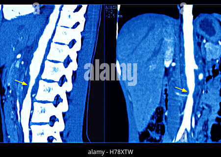 TAKAYASU ARTERITE DELL Foto Stock