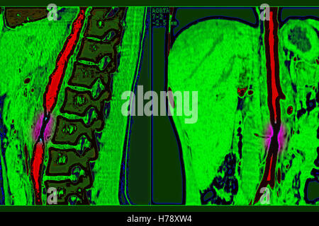 TAKAYASU ARTERITE DELL Foto Stock