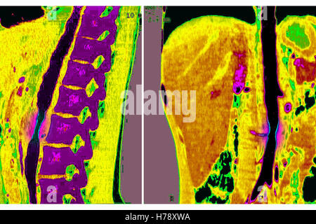 TAKAYASU ARTERITE DELL Foto Stock