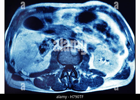 Il cancro al fegato, scansione Foto Stock