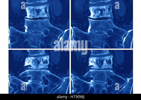 Il morbo di Paget, MRI Foto Stock