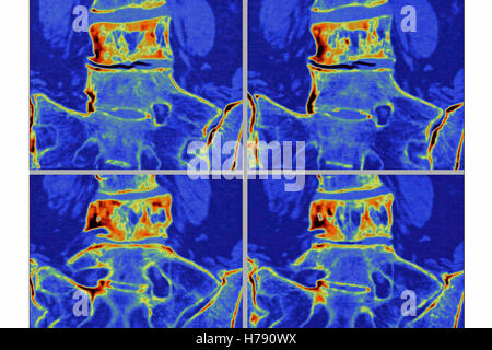 Il morbo di Paget, MRI Foto Stock