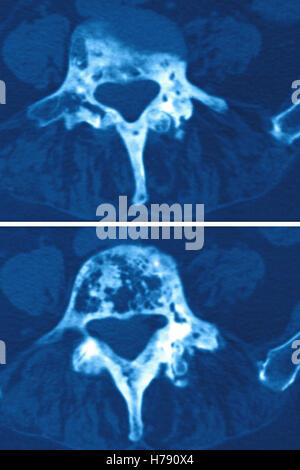 Il morbo di Paget, MRI Foto Stock