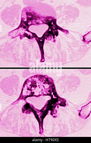 Il morbo di Paget, MRI Foto Stock