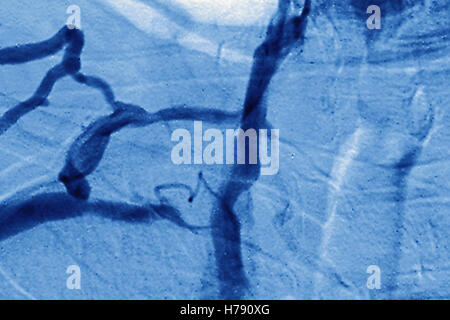 Stenosi venosa, angiografia Foto Stock