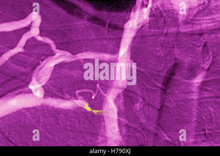 Stenosi venosa, angiografia Foto Stock