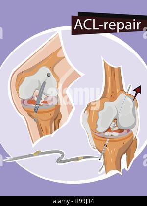 Illustrazione Vettoriale di riparazione del ginocchio Illustrazione Vettoriale