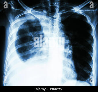 Film i raggi X al torace PA montante : mostra di versamento pleurico a destra del polmone a causa di cancro ai polmoni Foto Stock