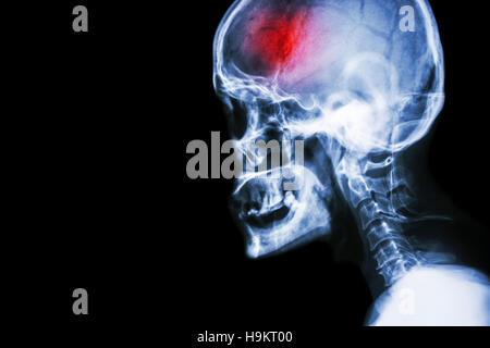 Stroke . il film x-ray del cranio e della colonna vertebrale cervicale vista laterale e corsa . accidente cerebrovascolare . La zona vuota a sinistra . Foto Stock